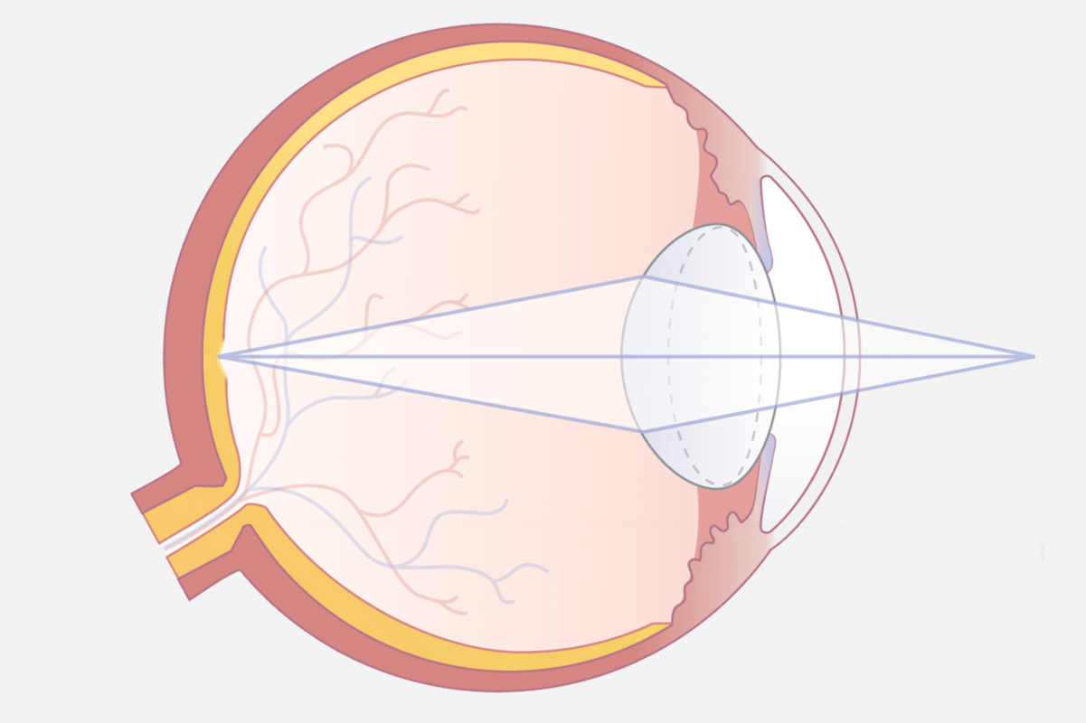 Akkommodation bei jungen Menschen ermöglicht scharfe Sicht auch in der Nähe.