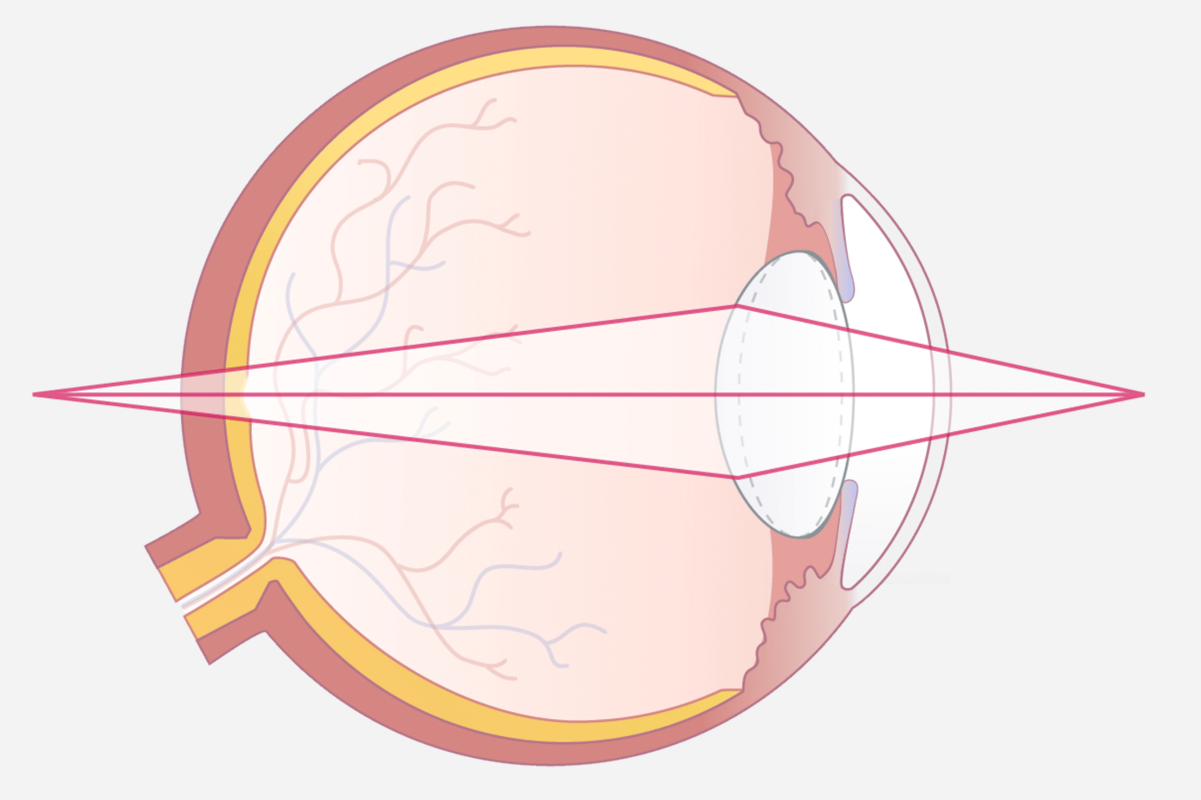 Ungenügende Akkommodation bei älteren Menschen verschlechtert das Nahsehen.