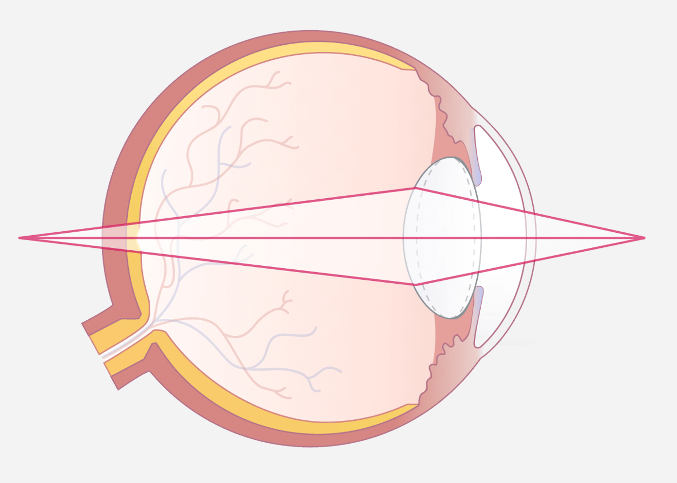 Ungen&uuml;gende Akkommodation bei &auml;lteren Menschen verschlechtert das Nahsehen.