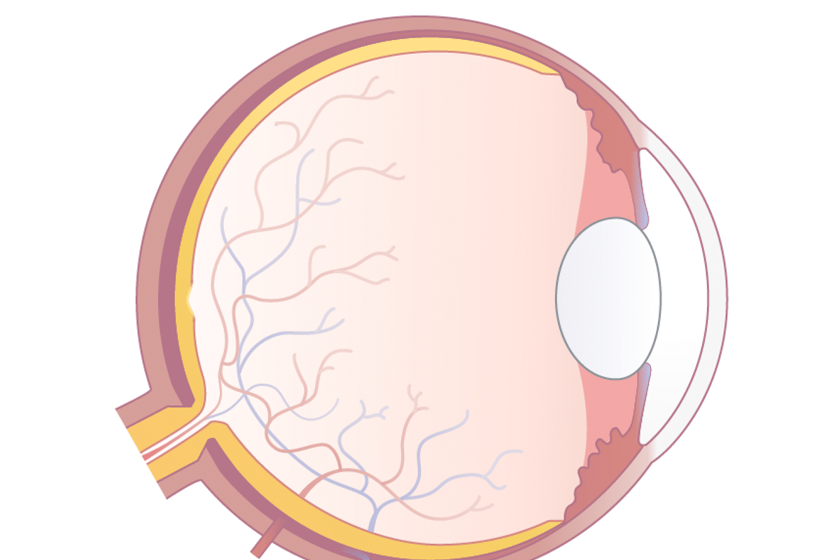 Querschnitt des Auges mit kugelig geformter Linse.