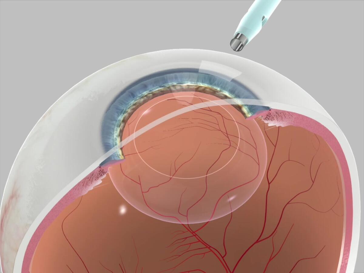 Einsatz der Phacoemulsifikation.