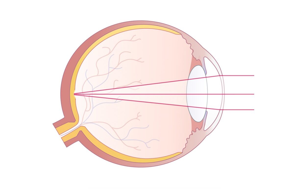 Kurzsichtiges Auge nach einer Augenlaserkorrektur mit Darstellung der einfallenden Lichtstrahlen, die sich nun auf der Netzhaut bündeln.