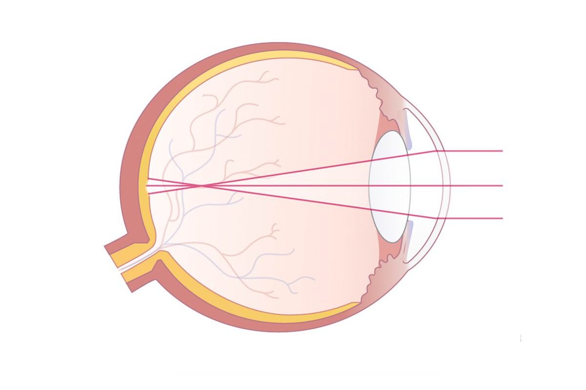 Kurzsichtiges Auge mit Darstellung der einfallenden Lichtstrahlen, die sich vor der Netzhaut bündeln.