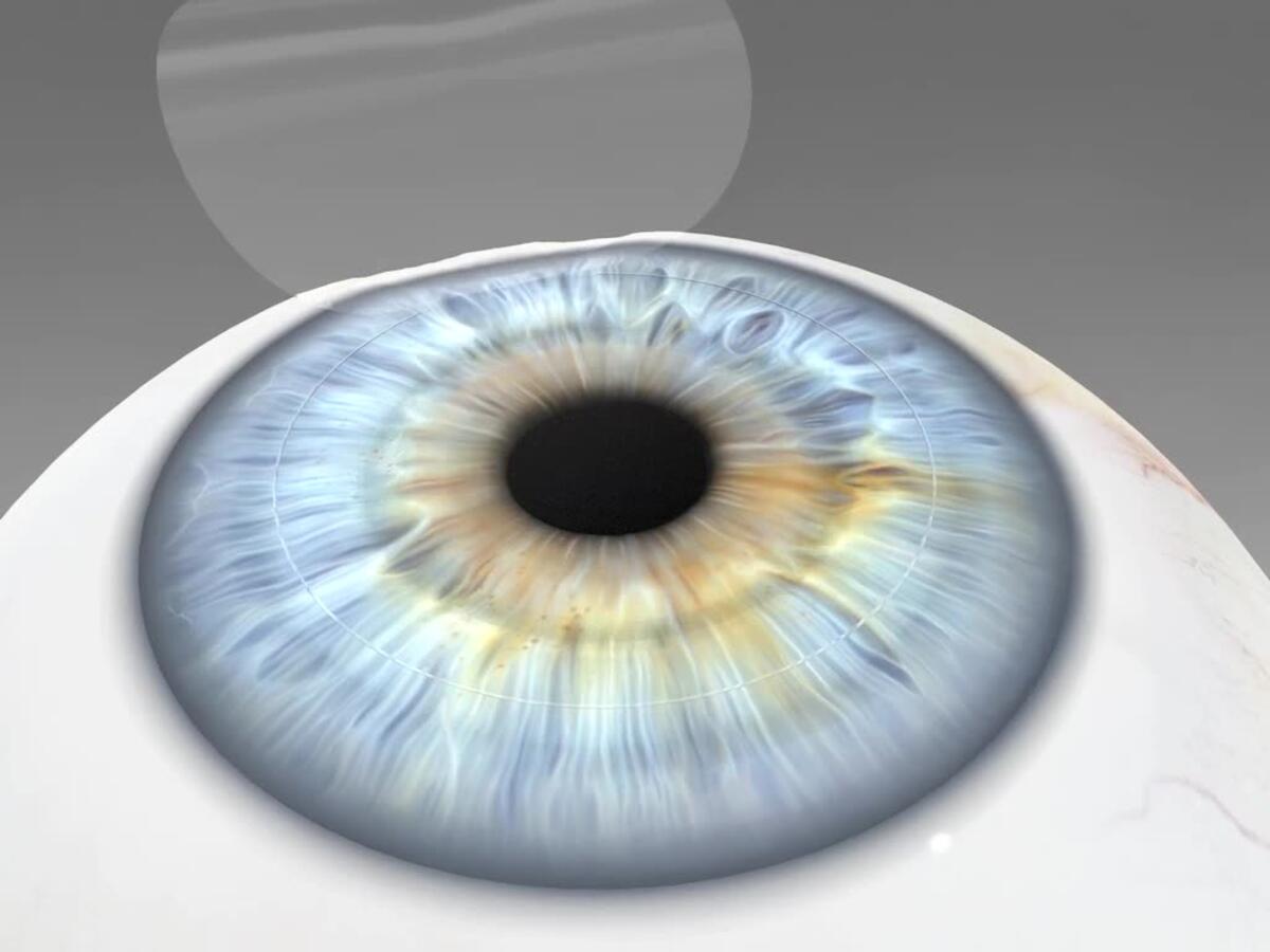 Anheben des Flaps bei der Femto-LASIK.