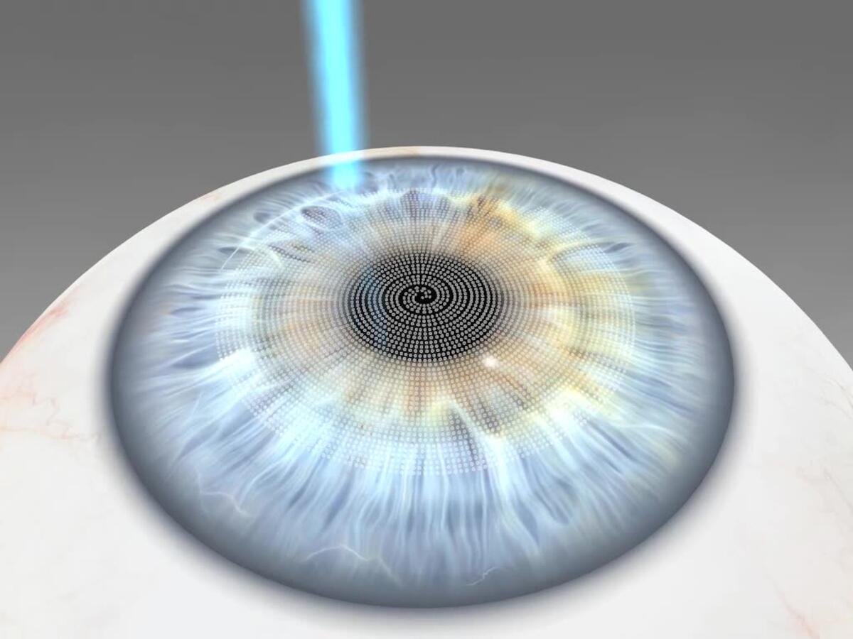 Der Femtosekundenlaser präpariert den Flap.