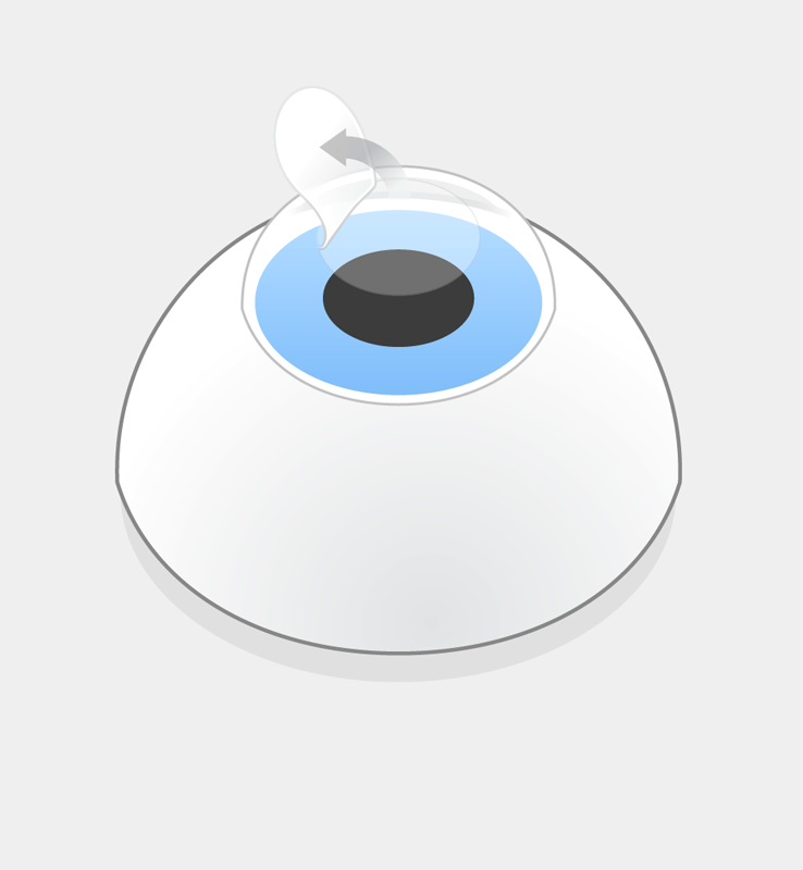 Darstellung eines Flaps bei der LASIK.