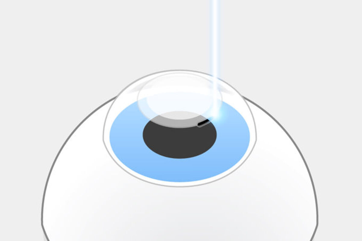 SMILE pro Schritt 2: Dann schneidet der Laser eine Öffnung von 2-3 mm in die Hornhautoberfläche.