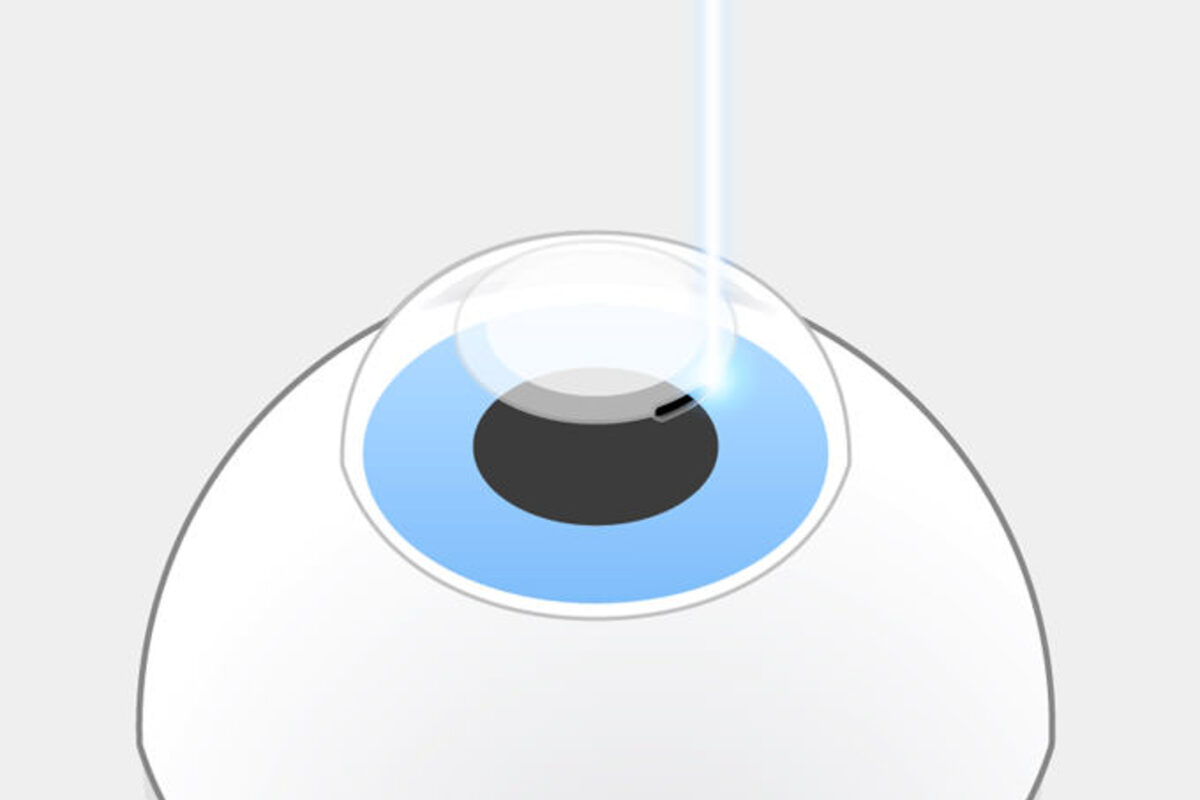 SMILE pro Schritt 2: Dann schneidet der Laser eine Öffnung von 2-3 mm in die Hornhautoberfläche.