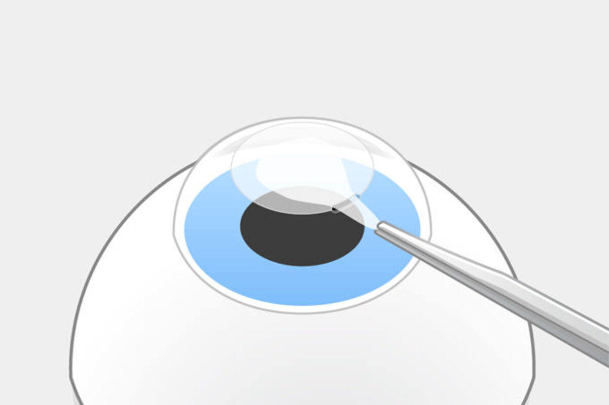 SMILE pro Schritt 3: Der Operateur löst das Lentikel und zieht es durch die Öffnung heraus. Das Auge bleibt stabil.