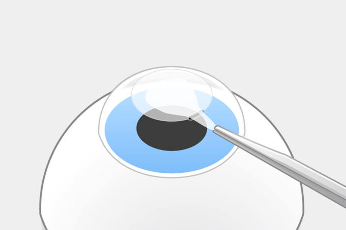SMILE pro Schritt 3: Der Operateur löst das Lentikel und zieht es durch die Öffnung heraus. Das Auge bleibt stabil.