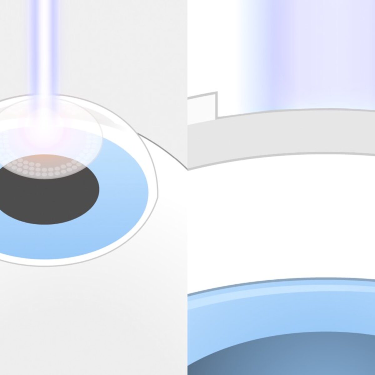 TransPRK Augenlasern Schritt 1: Vergrößerung und Seitenansicht: Rechts sieht man, dass der Laser erst die oberste Schicht, das Epithel, entfernt und anschließend das darunter liegende Hornhautgewebe formt.