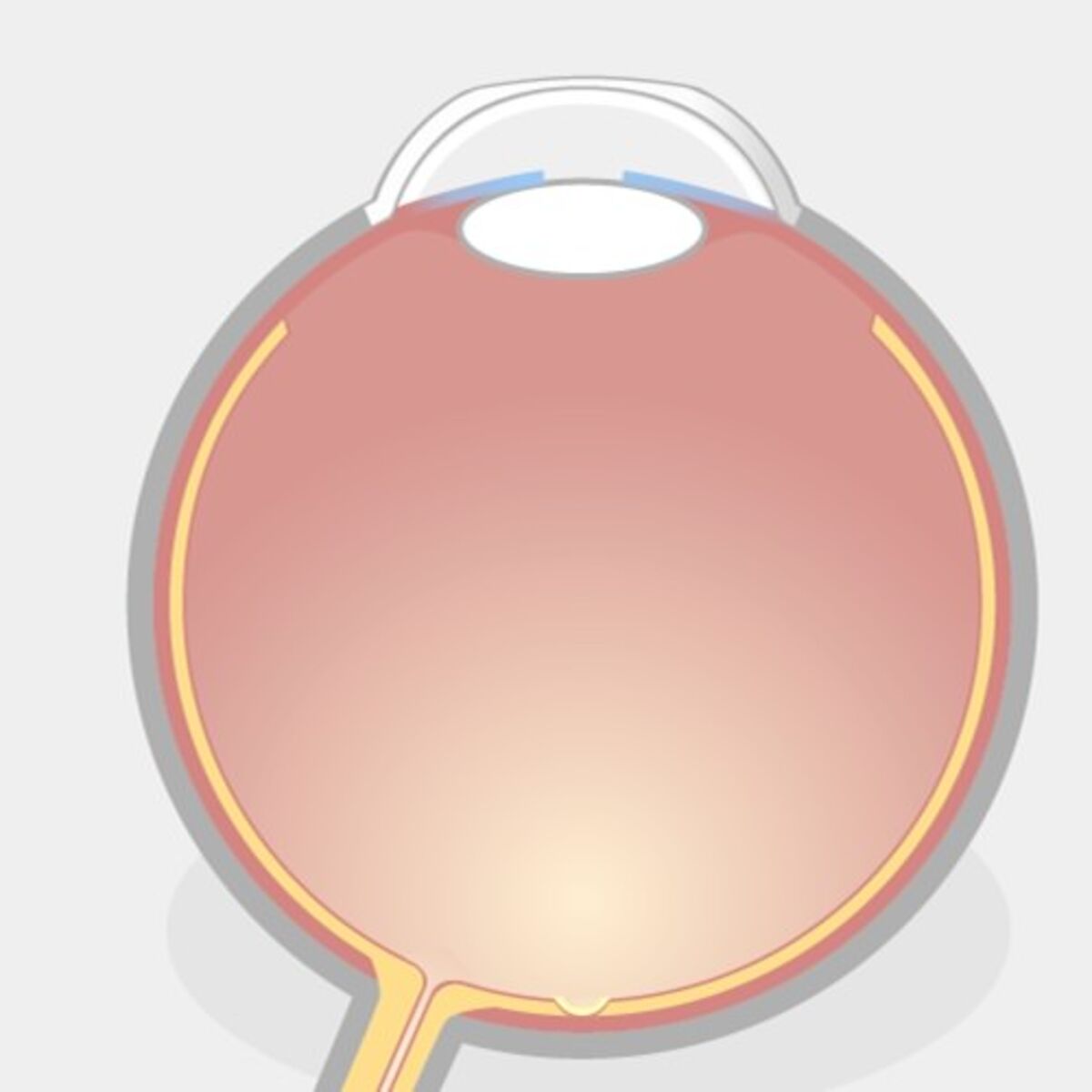 TransPRK Augenlasern Schritt 2: Illustration eines Auges mit abgeflachter Hornhaut nach der TransPRK.