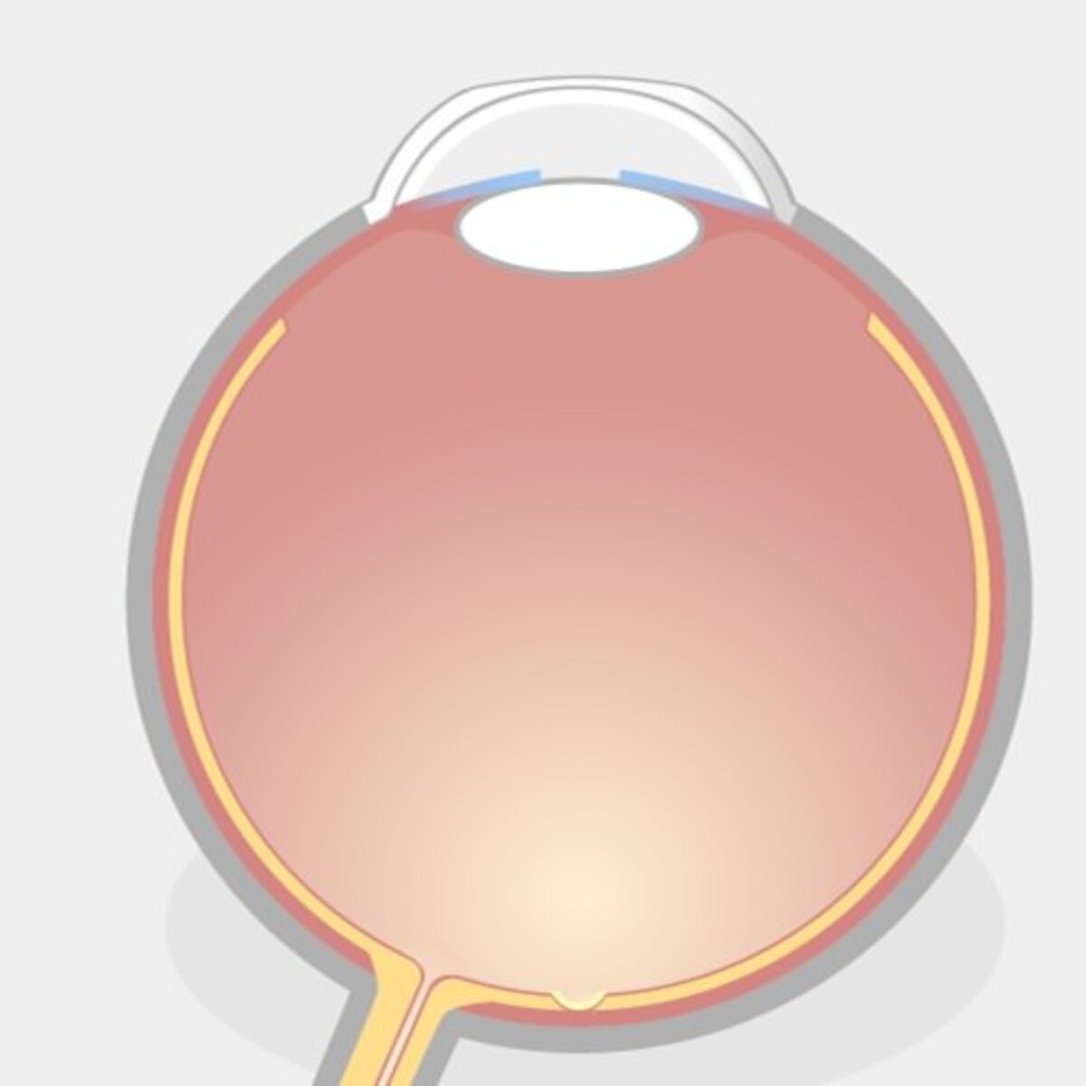 TransPRK Augenlasern Schritt 2: Illustration eines Auges mit abgeflachter Hornhaut nach der TransPRK.