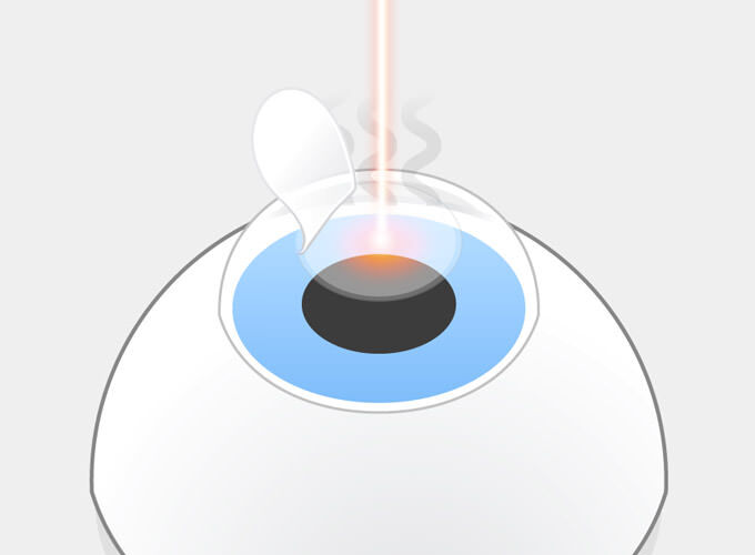 LASIK Schritt 3: Lichtpulse des Excimerlasers verdampfen einzelne Bereiche der freigelegten Hornhaut. Es entstehen unangenehme Gerüche.