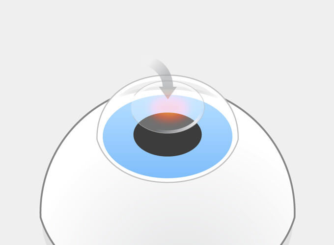 LASIK Schritt 4: Der Flap wird zurückgeklappt. Er vernarbt an den Rändern, wächst aber nie mehr richtig fest.