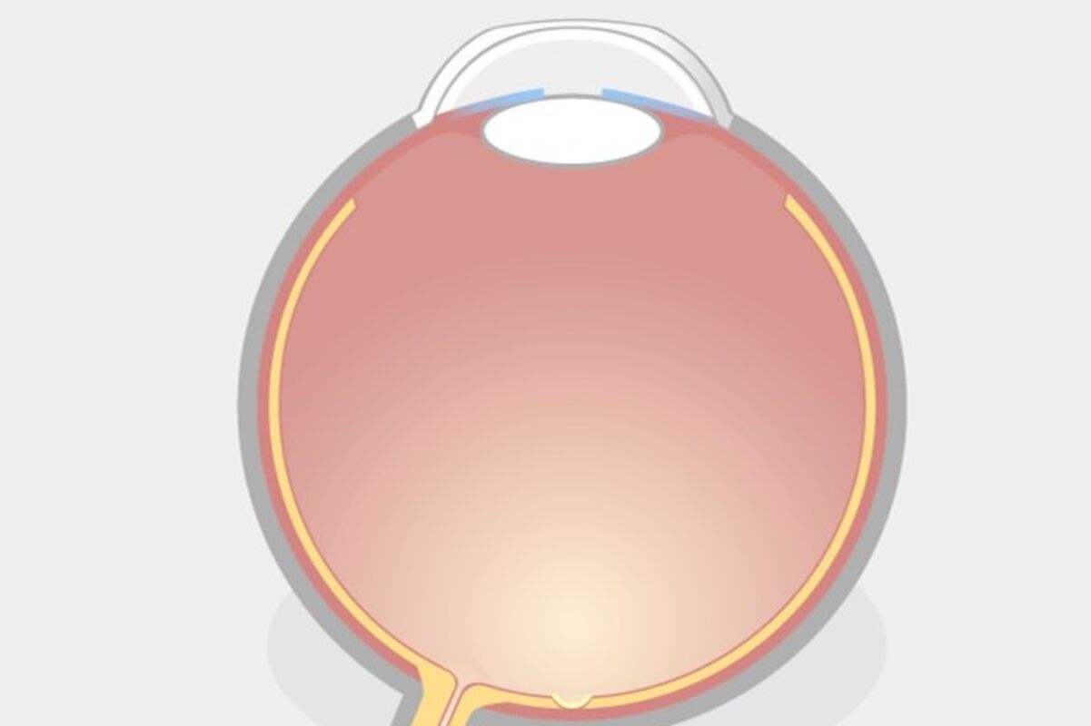 TransPRK Augenlasern Schritt 2: Nach der TransPRK-Behandlung ist die Hornhaut ohne Schutzschicht, deshalb muss eine schützende Kontaktlinse getragen werden. Schmerzen dauern 1 bis 2 Tage, währenddessen ist das Infektionsrisiko erhöht.