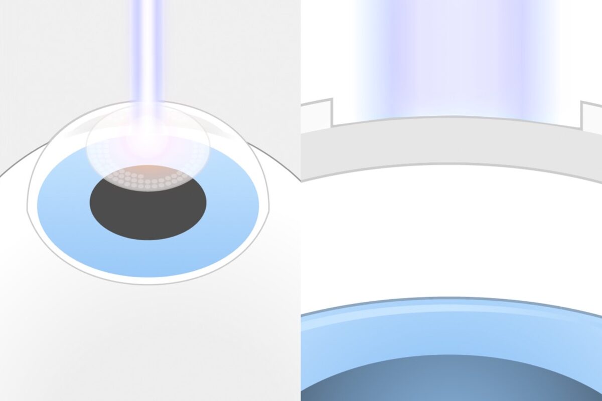 TransPRK Augenlasern Schritt 1: (Vergrößerung und Seitenansicht): Rechts sieht man, dass der Laser erst die oberste Schicht, das Epithel, entfernt und anschließend das darunter liegende Hornhautgewebe formt.