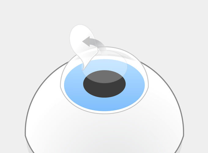 LASIK Schritt 2: Der Flap wird wie ein Deckel zur Seite aufgeklappt.