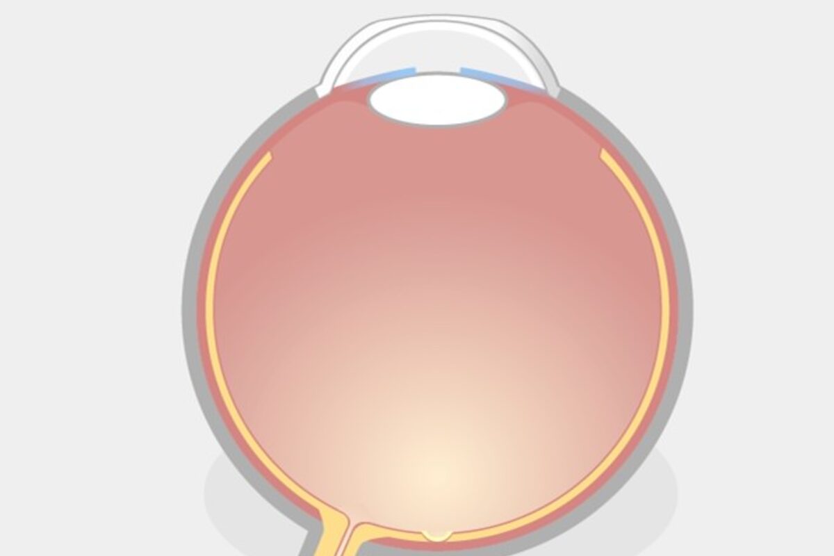 TransPRK Augenlasern Schritt 2: Nach der TransPRK-Behandlung ist die Hornhaut ohne Schutzschicht, deshalb muss eine schützende Kontaktlinse getragen werden. Schmerzen dauern 1 bis 2 Tage, währenddessen ist das Infektionsrisiko erhöht.