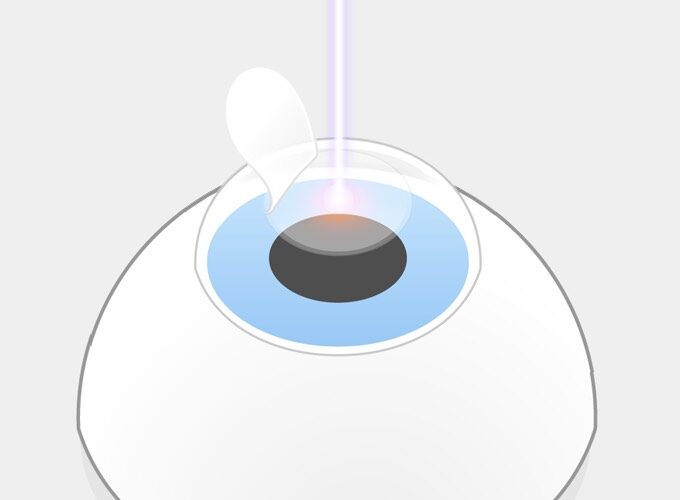 Femto-LASIK Schritt 3: Lichtpulse des Excimerlasers verdampfen einzelne Bereiche der freigelegten Hornhaut.