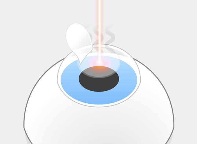 LASIK Schritt 3: Lichtpulse des Excimerlasers verdampfen einzelne Bereiche der freigelegten Hornhaut. Es entstehen unangenehme Gerüche.