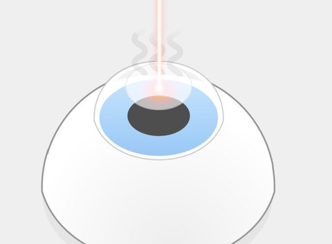 PRK Augenlasern Schritt 2: Anschließend verdampfen Lichtpulse des Excimerlasers einzelne Bereiche der freigelegten Hornhaut, während der Patient einen Lichtpunkt fixiert. Es entstehen unangenehme Gerüche.