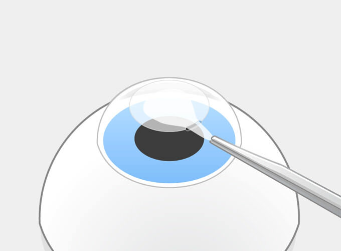SMILE Schritt 3: Der Operateur löst das Lentikel und zieht es durch die Öffnung heraus. Das Auge bleibt stabil.