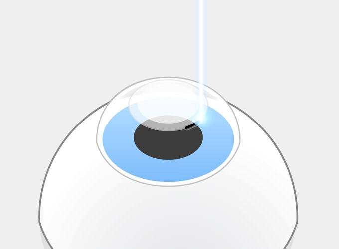 SMILE Schritt 2: Dann schneidet der Femtosekundenlaser eine Öffnung von 2-4 mm in die Hornhautoberfläche.