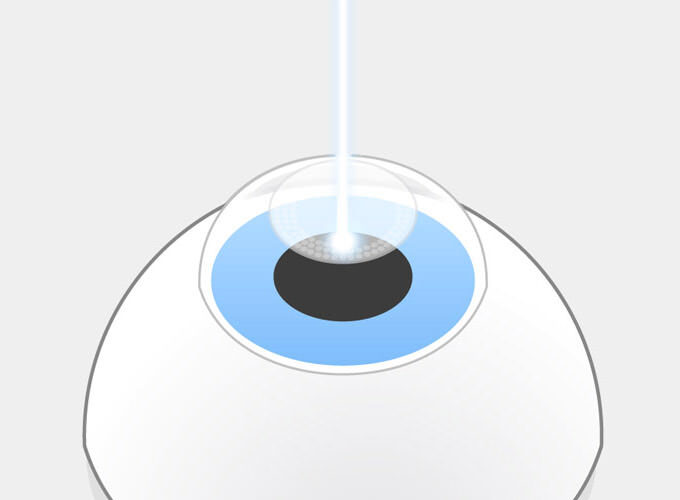 Femto-LASIK Schritt 1: Der Femtosekundenlaser präpariert den Flap und durchtrennt dabei auch Hornhautnerven. Dadurch entsteht ein trockenes Auge.