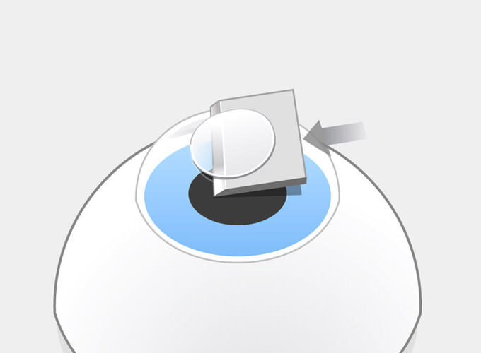 LASIK Schritt 1: Der Flapschnitt wird mit einem Mikrokeratom bis auf eine kleine Verbindung abgehobelt und durchtrennt dabei Hornhautnerven. Dadurch entsteht ein trockenes Auge.