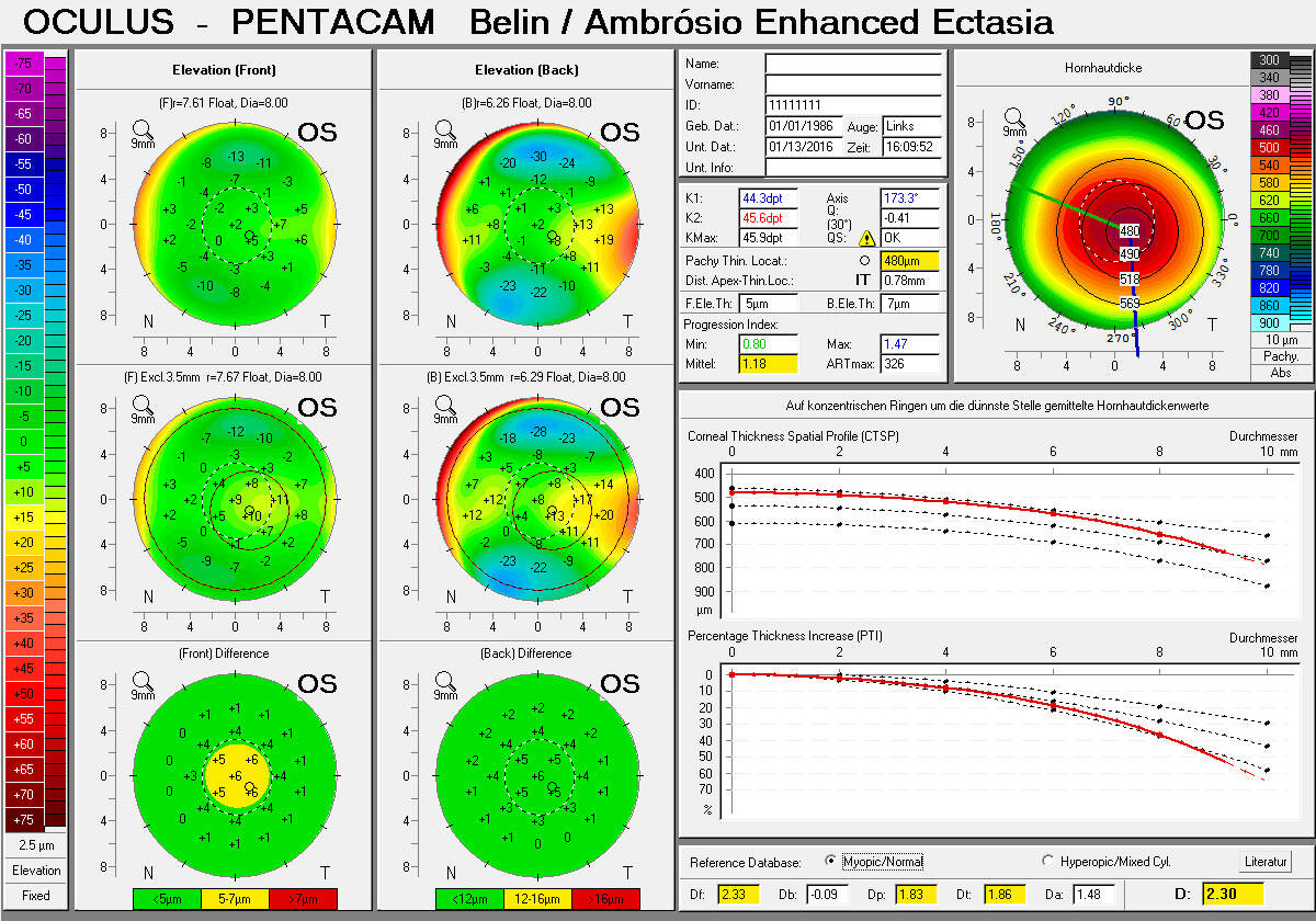Pentacam Belin/Ambrosio