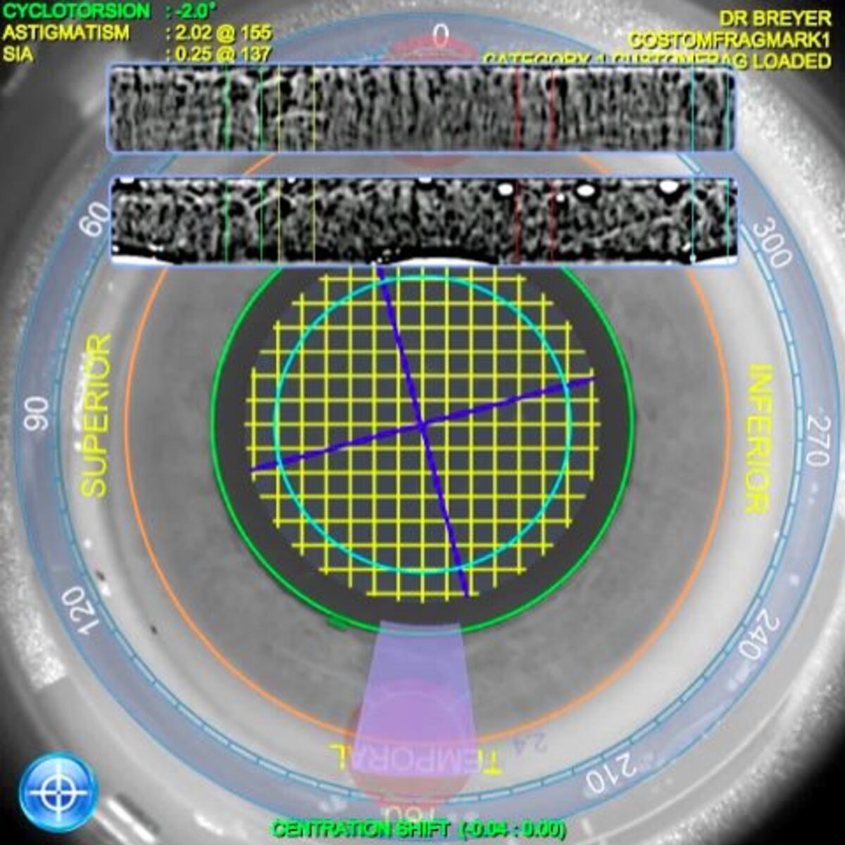 Darstellung der Irisregistrierung mit dem LENSAR-Laser.