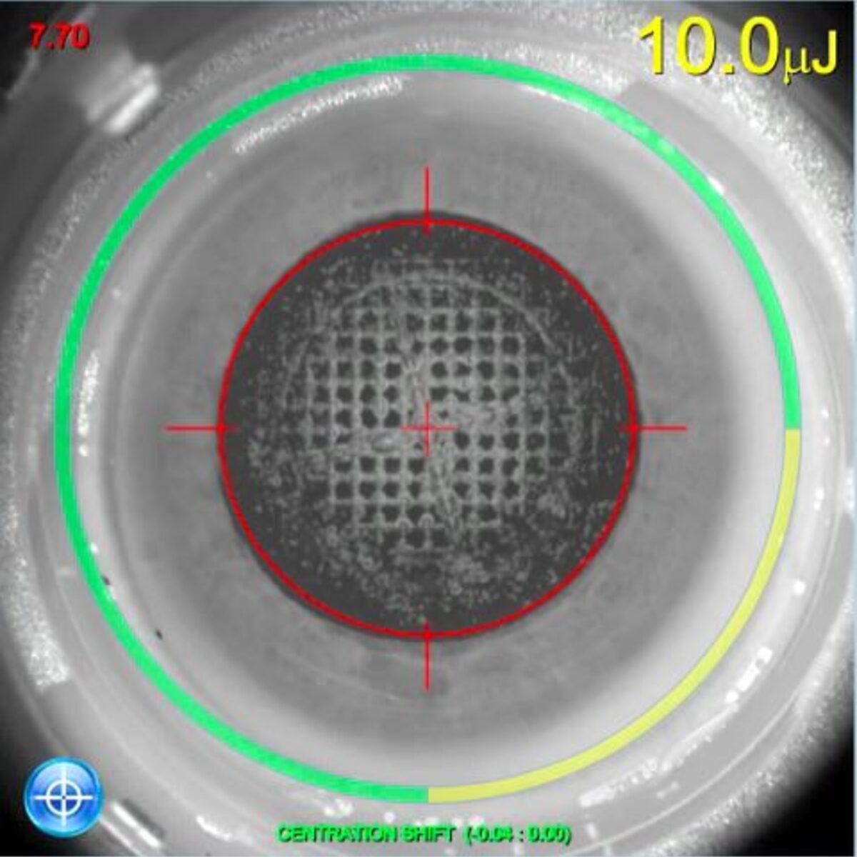 Monitorbild des LENSAR-Lasers, auf dem man das Muster erkennt, nach dem der Laser die natürliche Linse zerkleinert.