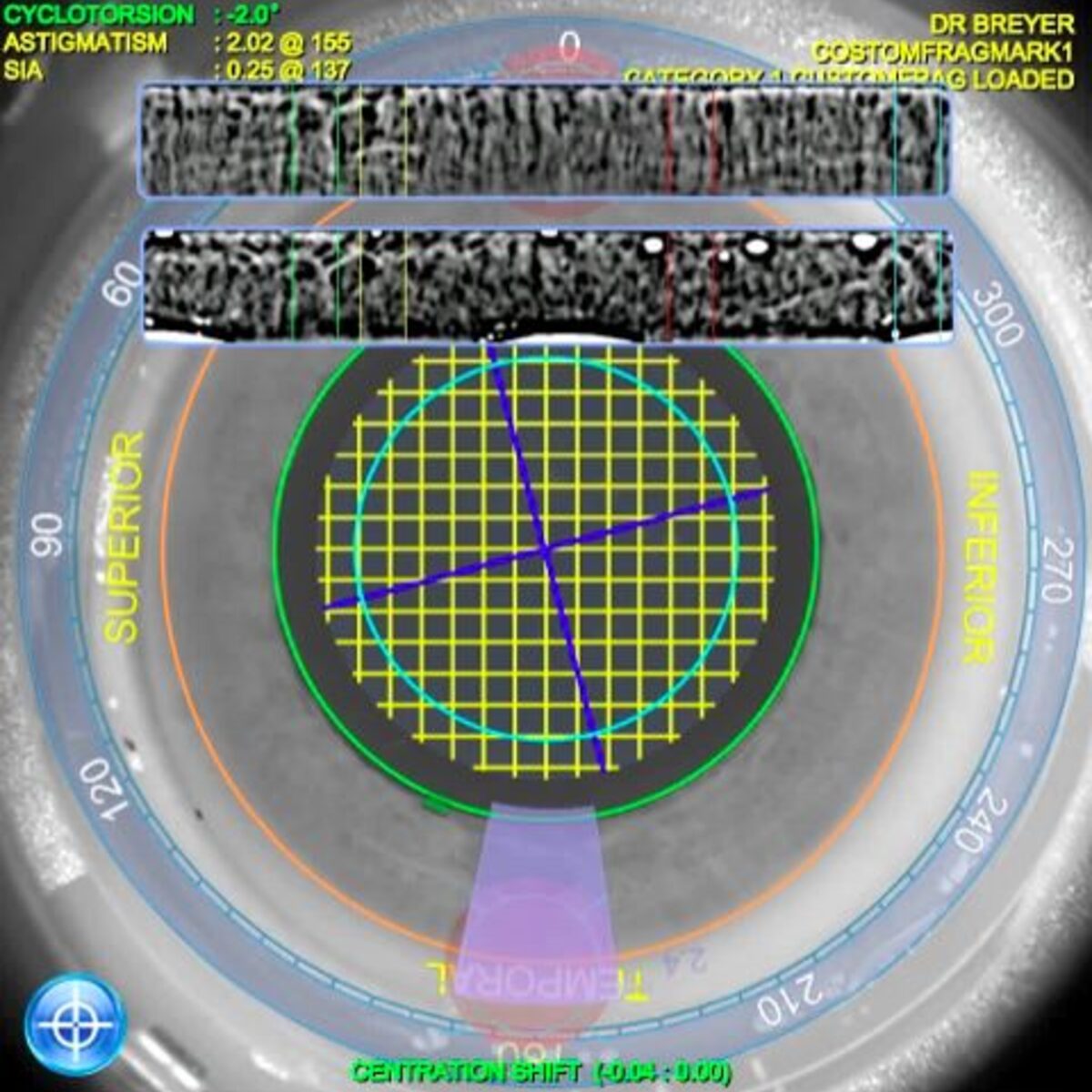 Darstellung der Irisregistrierung mit dem LENSAR-Laser.