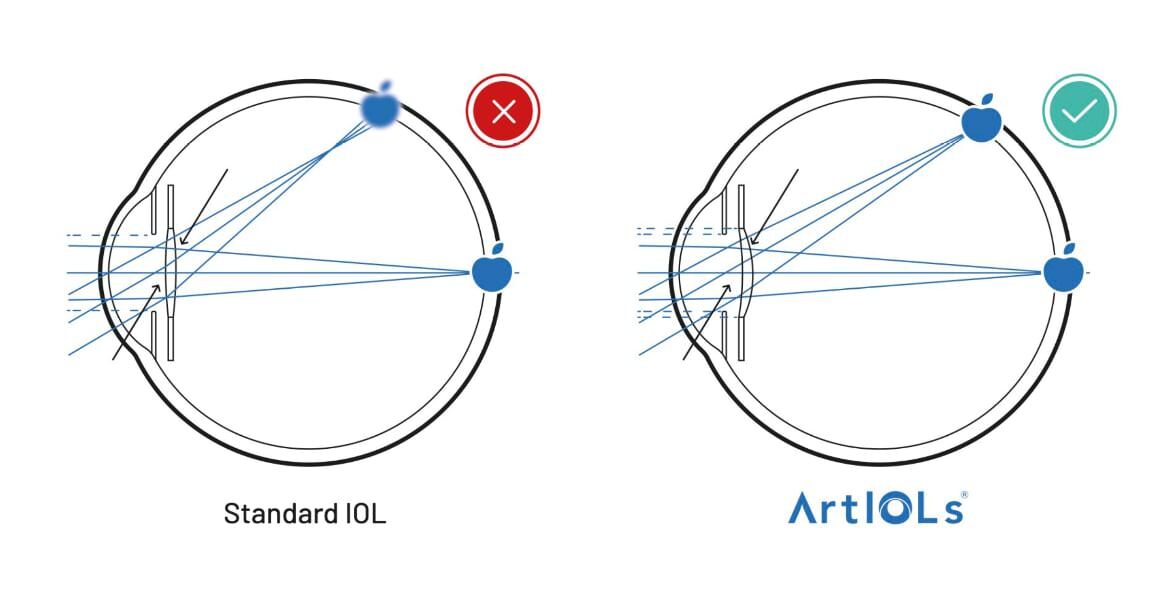Standard IOL vs. ArtIOLs
